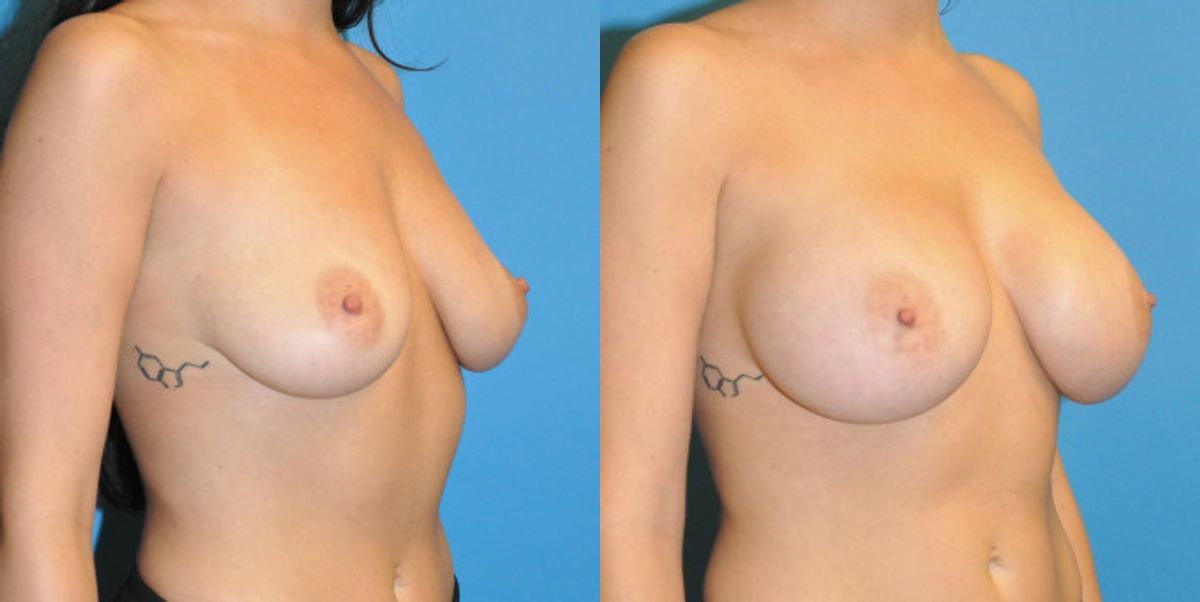 Breast Implant #45 - Before and After