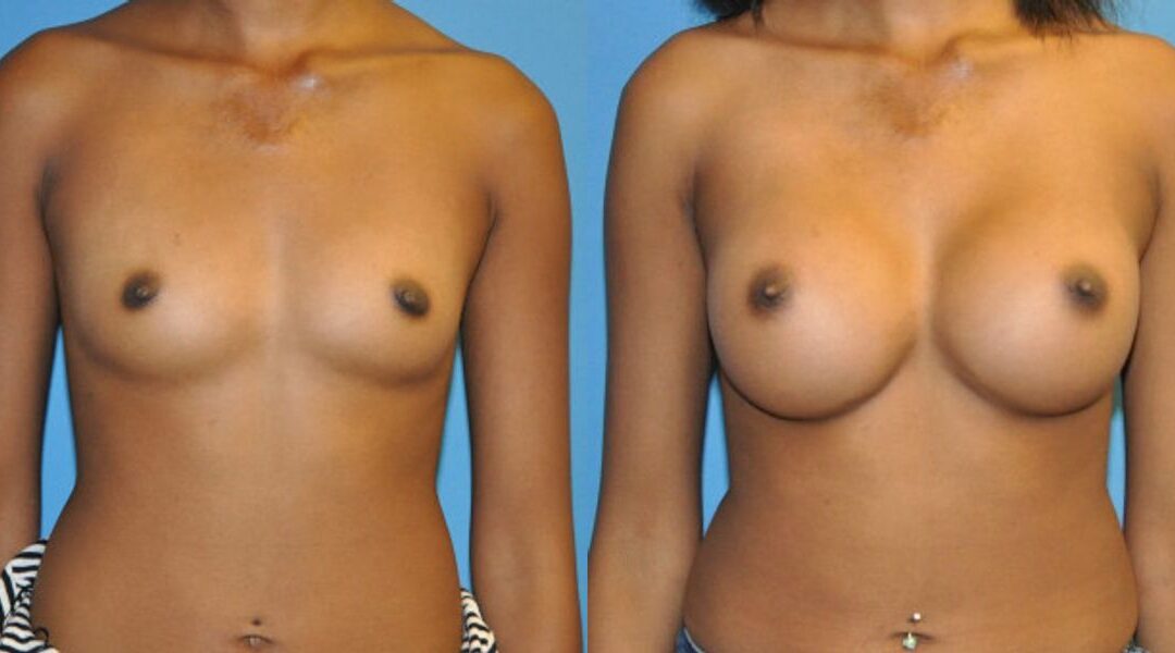 Breast Implant #46