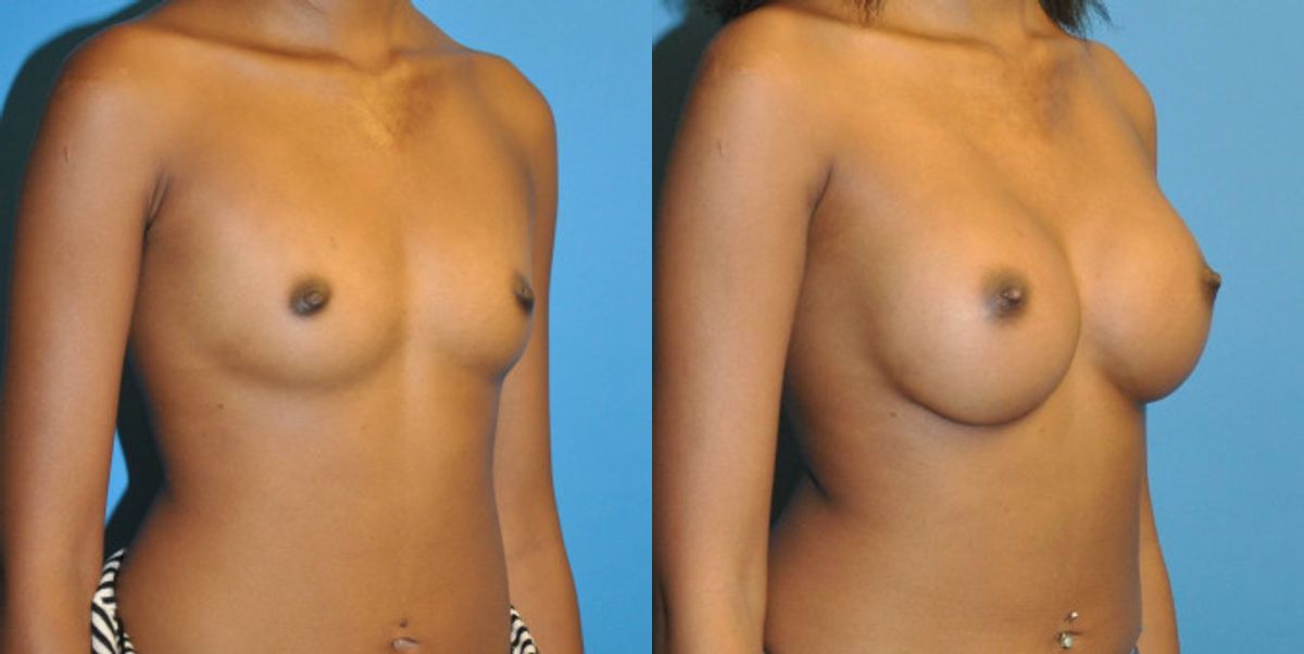 Breast Implant #46 - Before and After