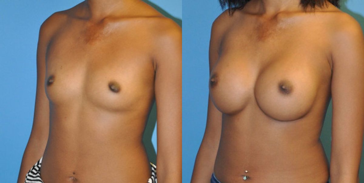 Breast Implant #46 - Before and After