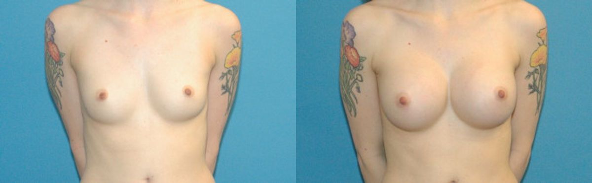 Breast Implant #47 - Before and After