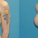 Breast Implant #47 - Before and After