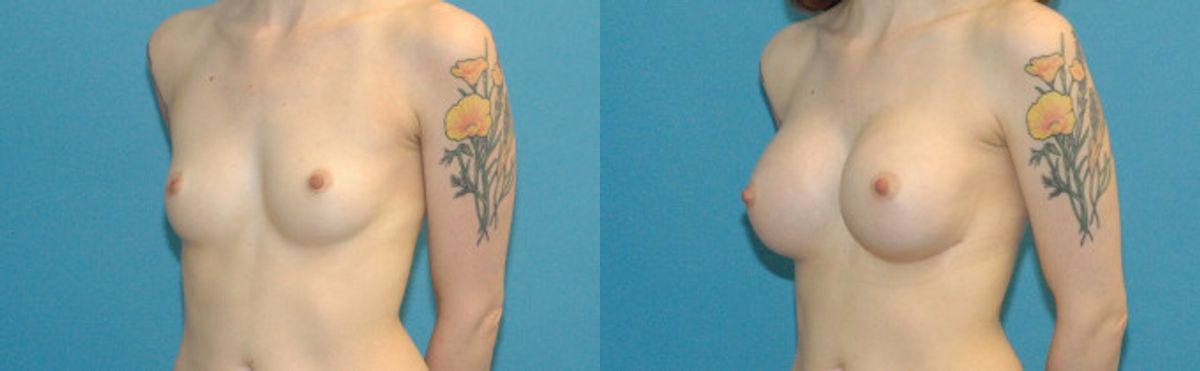 Breast Implant #47 - Before and After