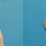 Breast Implant #47 - Before and After