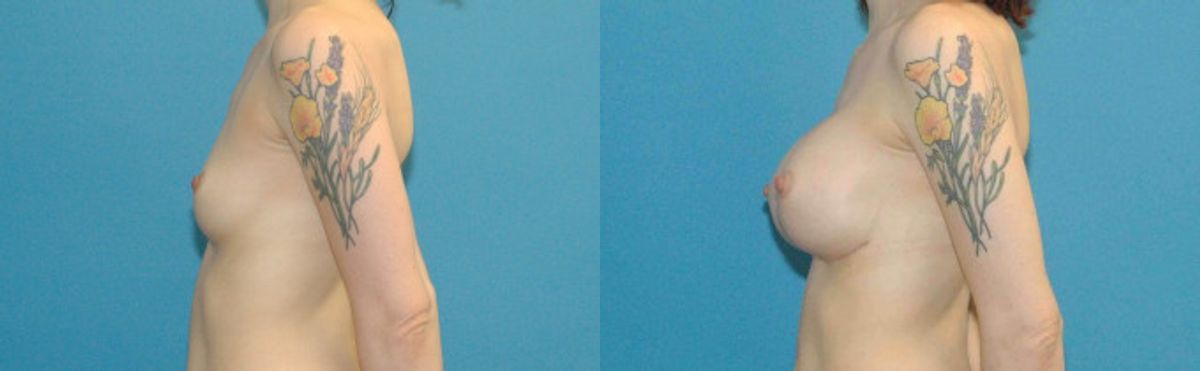 Breast Implant #47 - Before and After