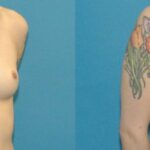 Breast Implant #47 - Before and After