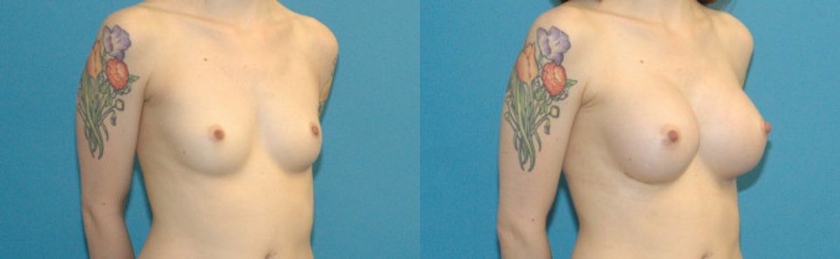 Breast Implant #47 - Before and After