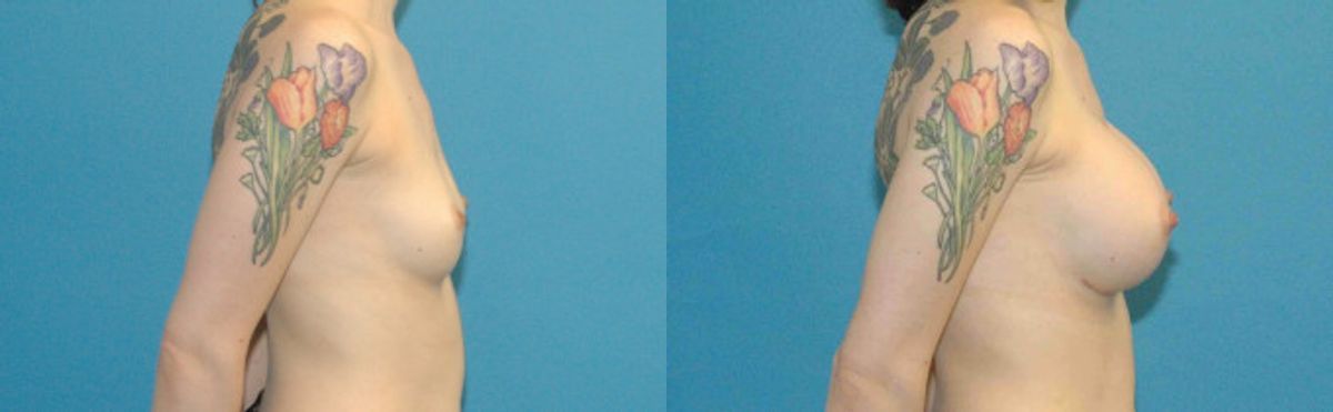 Breast Implant #47 - Before and After