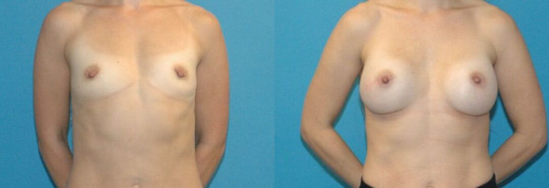 Breast Implant #48