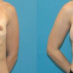 Breast Implant #48 - Before and After