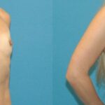 Breast Implant #48 - Before and After