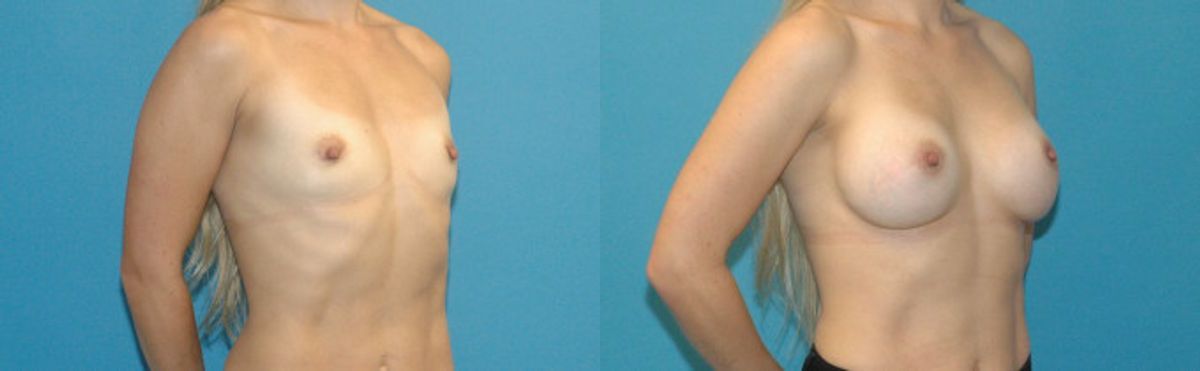 Breast Implant #48 - Before and After