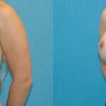Breast Implant #48 - Before and After