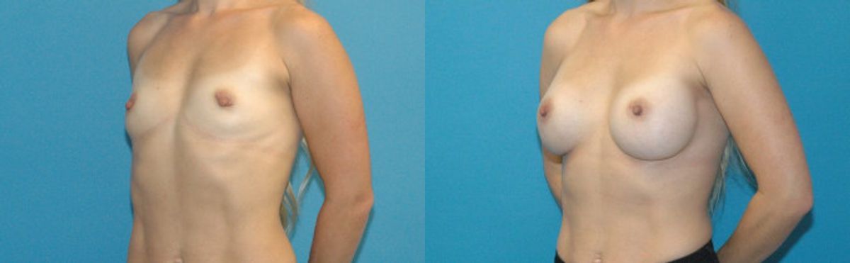 Breast Implant #48 - Before and After