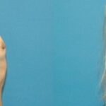 Breast Implant #48 - Before and After