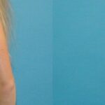 Breast Implant #48 - Before and After