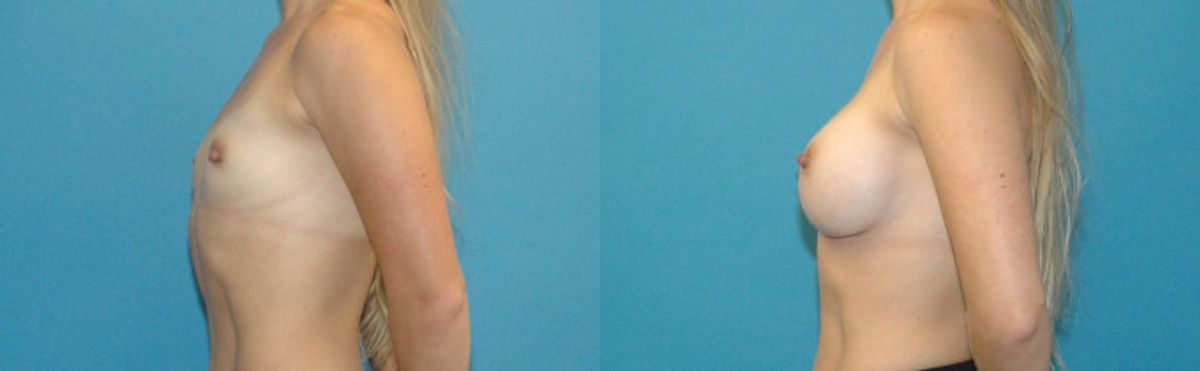 Breast Implant #48 - Before and After