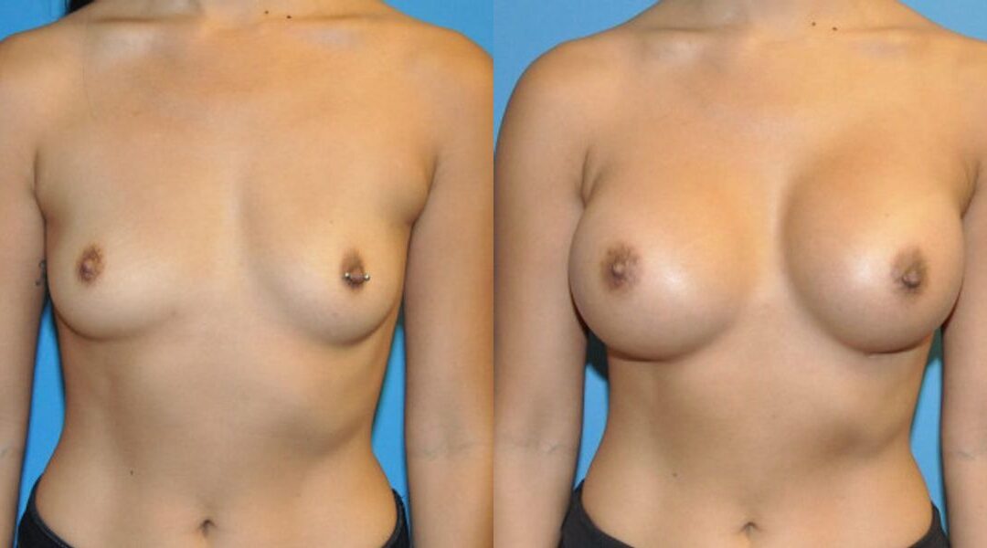 Breast Implant #49
