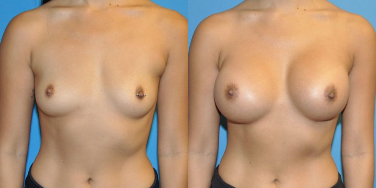 Breast Implant #49 - Before and After