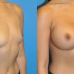 Breast Implant #49 - Before and After