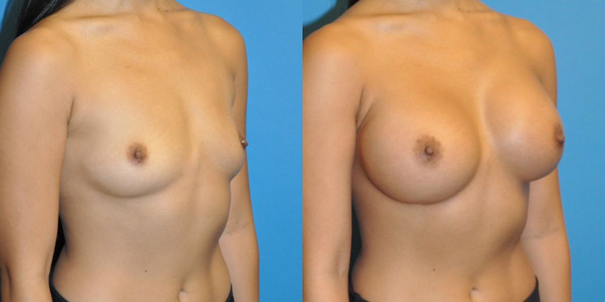 Breast Implant #49 - Before and After
