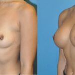 Breast Implant #49 - Before and After