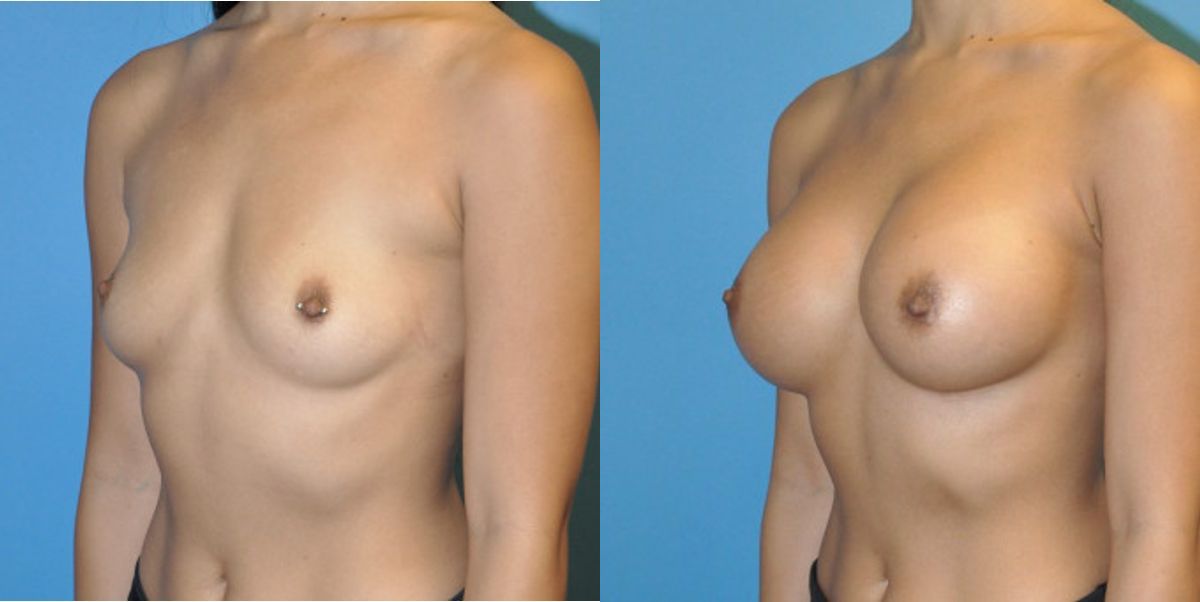 Breast Implant #49 - Before and After