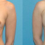 Breast Implant #50 - Before and After