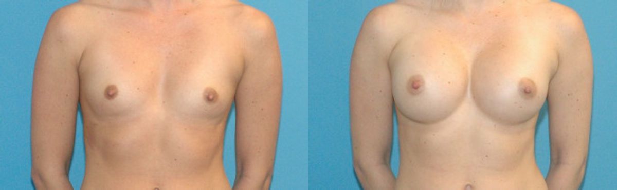 Breast Implant #50 - Before and After