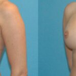 Breast Implant #50 - Before and After
