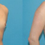Breast Implant #50 - Before and After