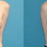 Breast Implant #51 - Before and After