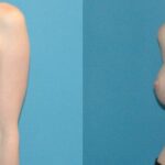 Breast Implant #51 - Before and After