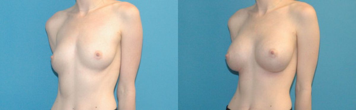 Breast Implant #51 - Before and After