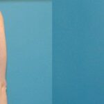 Breast Implant #51 - Before and After