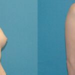 Breast Implant #51 - Before and After