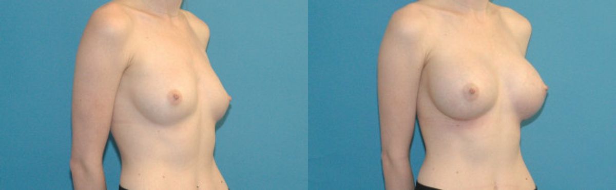 Breast Implant #51 - Before and After