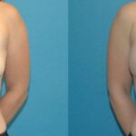 Breast Implant #52 - Before and After