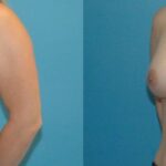 Breast Implant #52 - Before and After