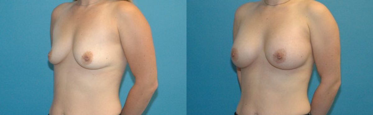 Breast Implant #52 - Before and After