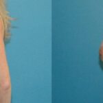 Breast Implant #52 - Before and After