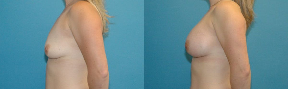 Breast Implant #52 - Before and After