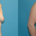 Breast Implant #52 - Before and After