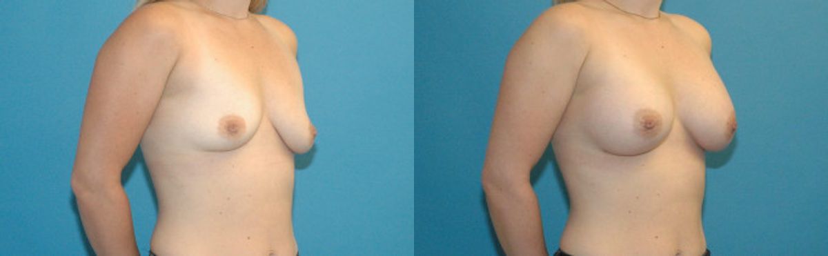Breast Implant #52 - Before and After