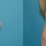 Breast Implant #52 - Before and After