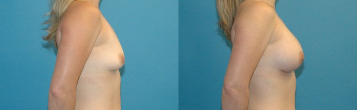 Breast Implant #52 - Before and After