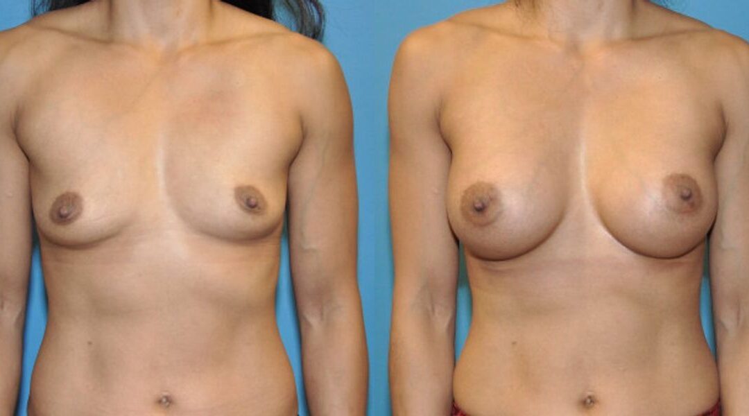Breast Implant #53