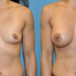 Breast Implant #53 - Before and After