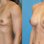 Breast Implant #53 - Before and After