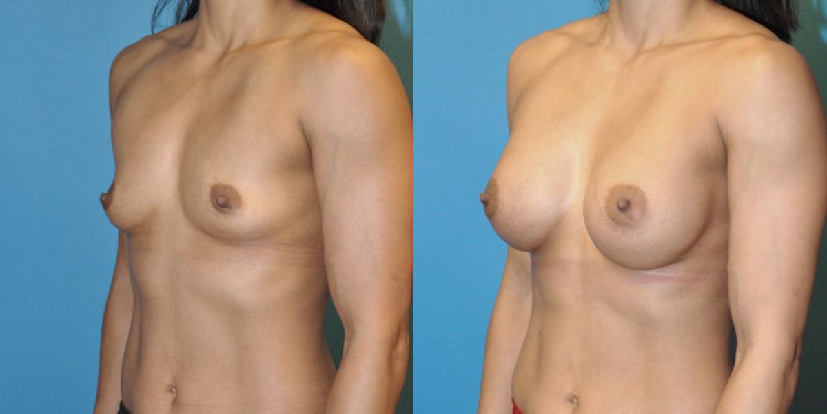 Breast Implant #53 - Before and After